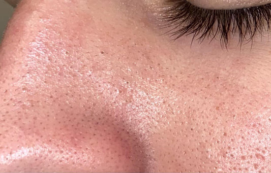 What is Sebaceous Filaments?